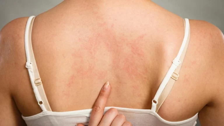 Kontakt dermatit nədir?