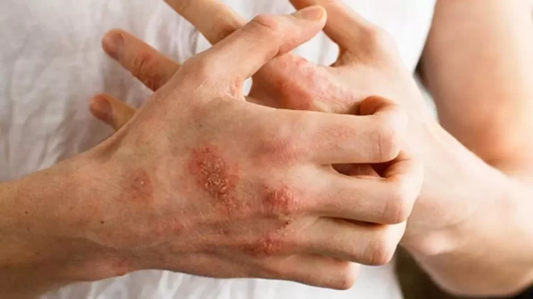 Atopik Dermatit nədir və necə görünür?