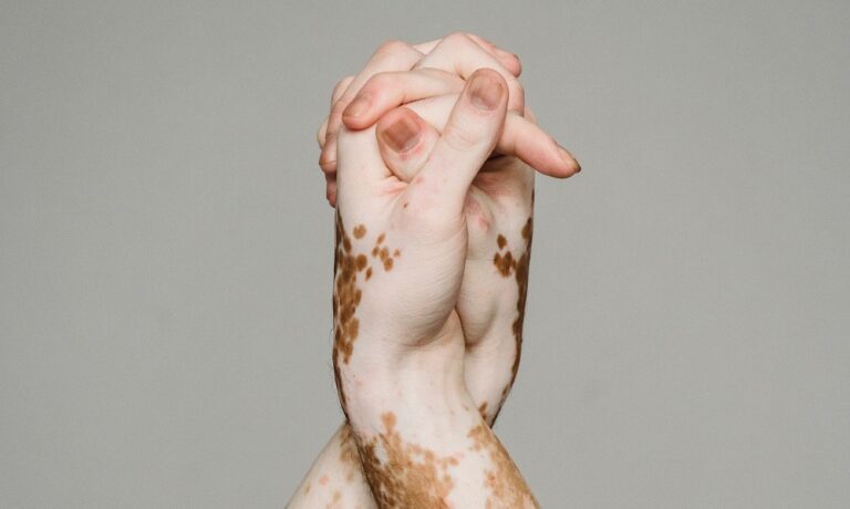 Vitiligo Nədir?