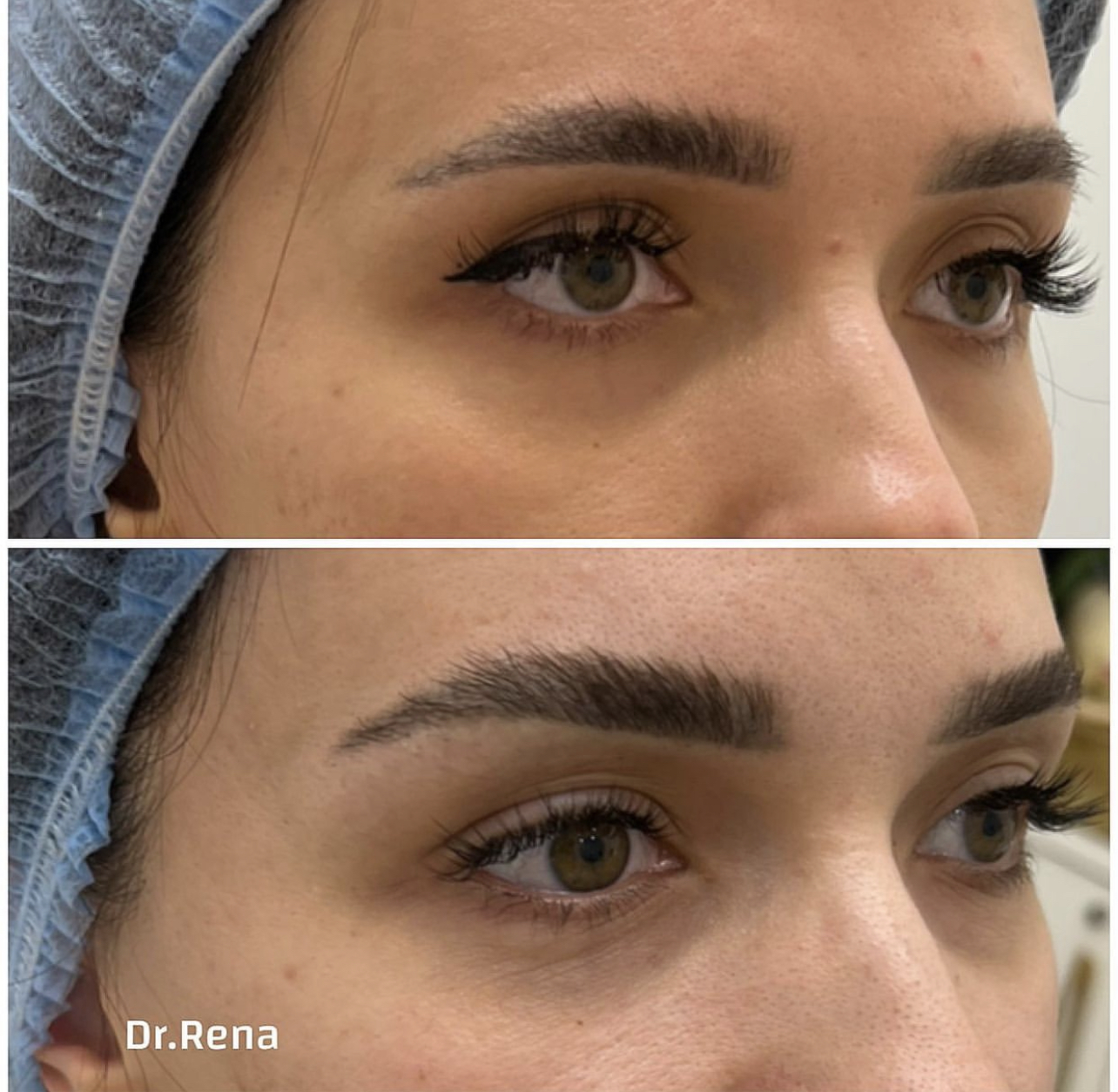 Browlift Image 6