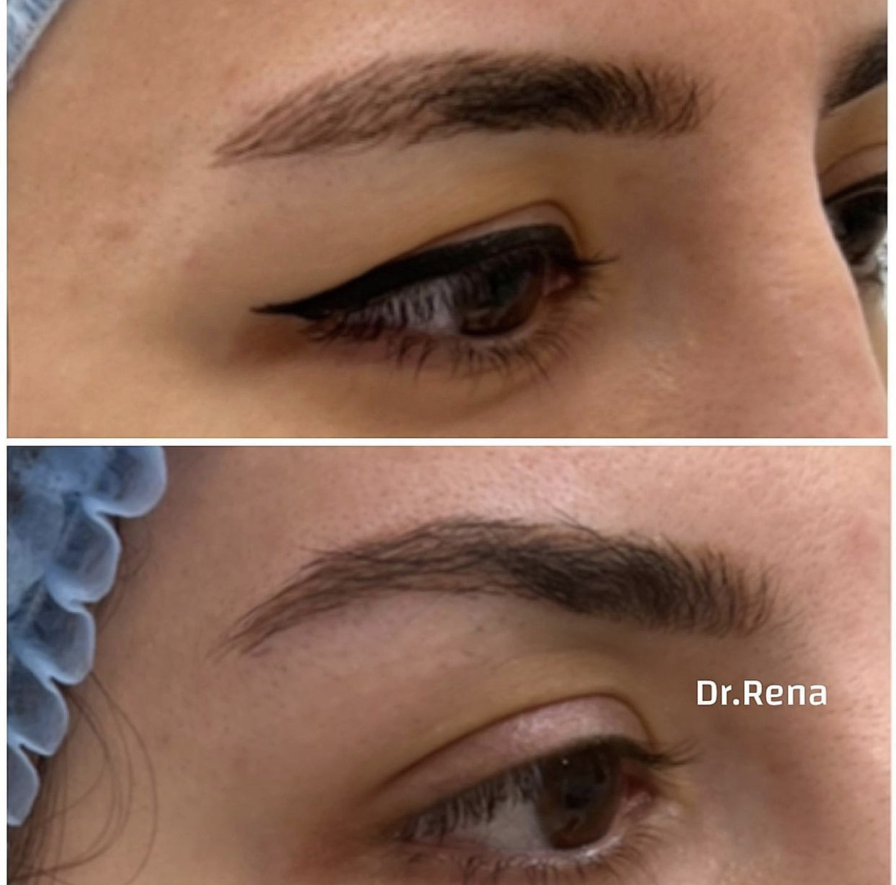Browlift Image 3