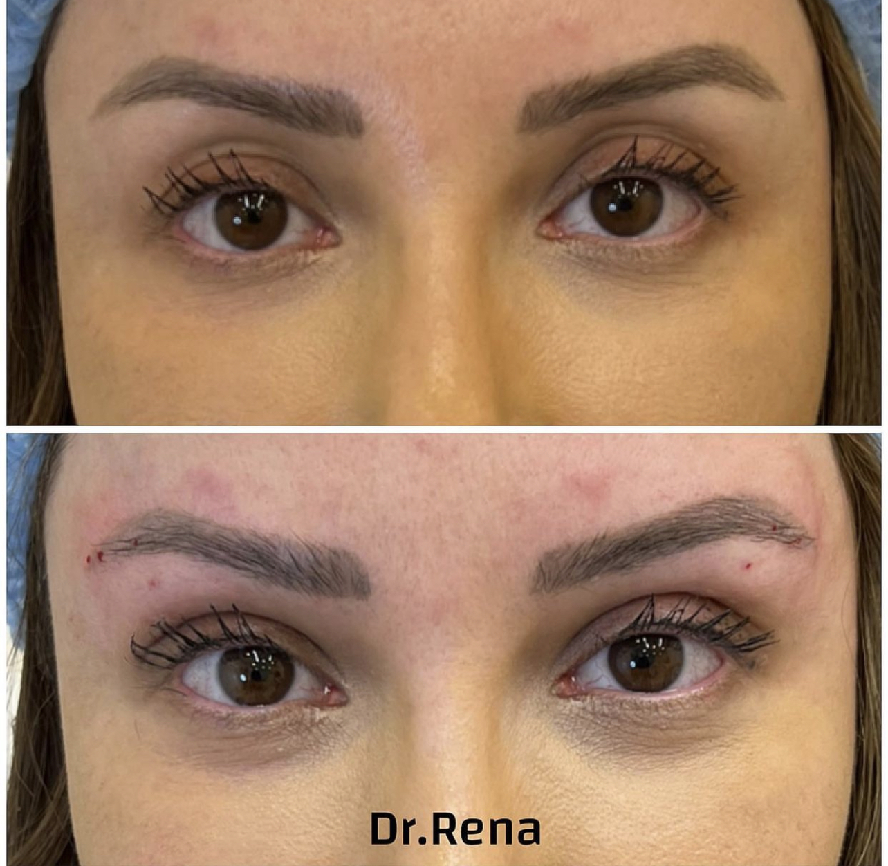 Browlift Image 5