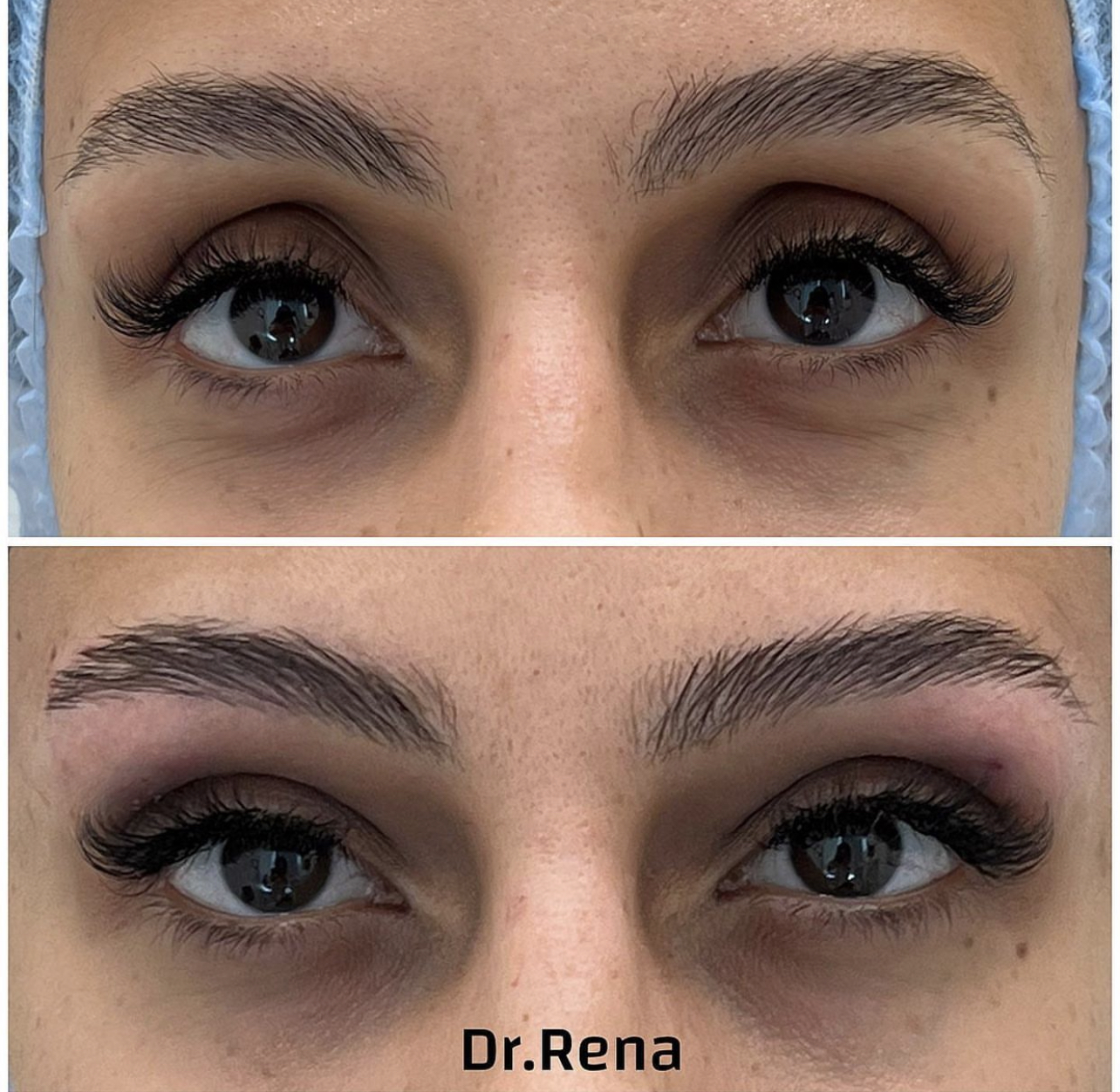 Browlift Image 1