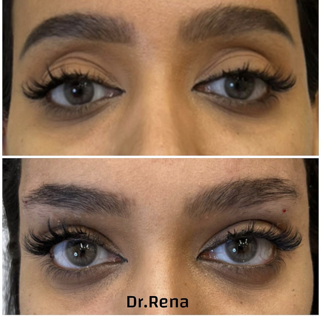 Browlift Image 2
