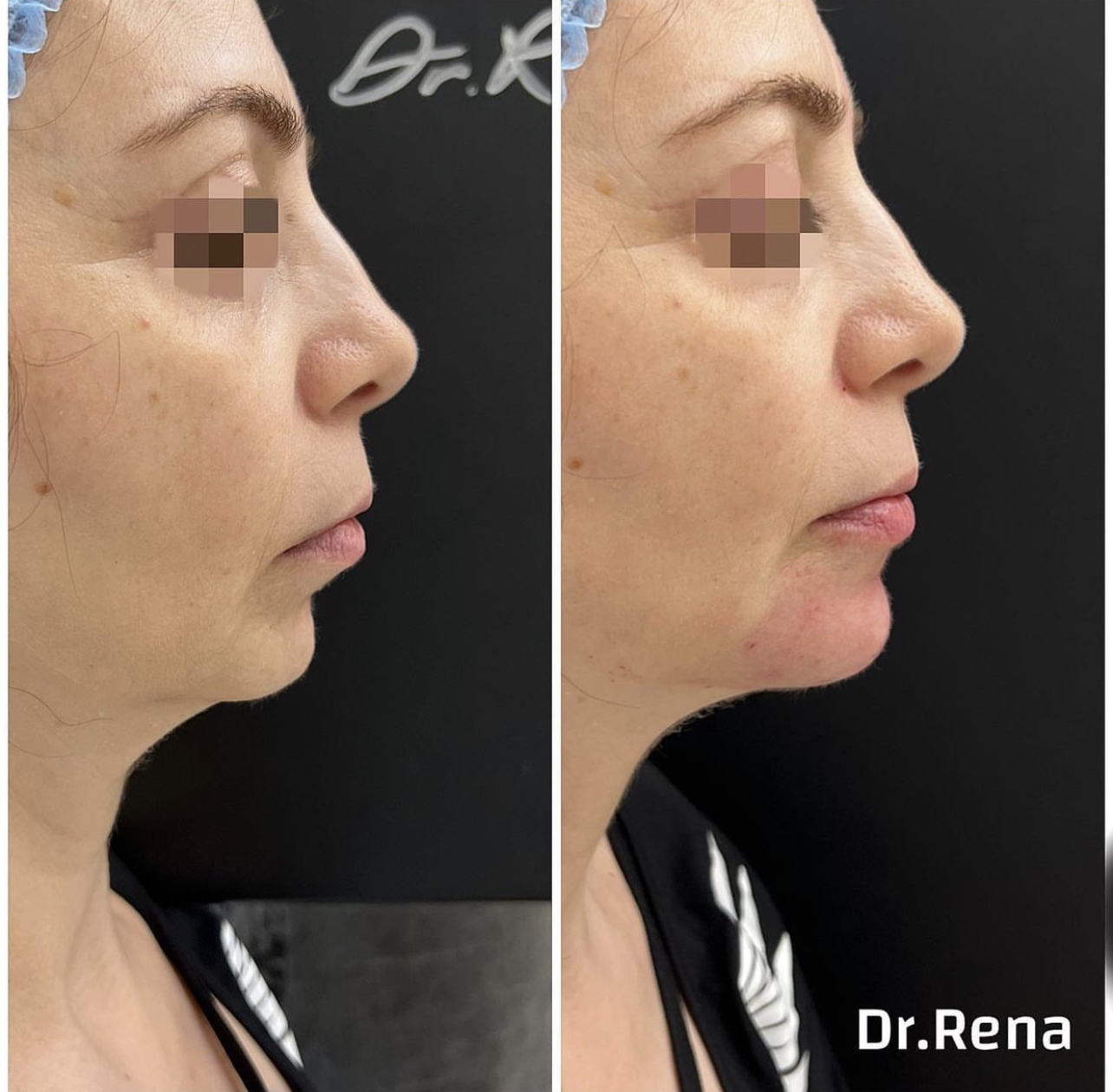Jawline Image 6